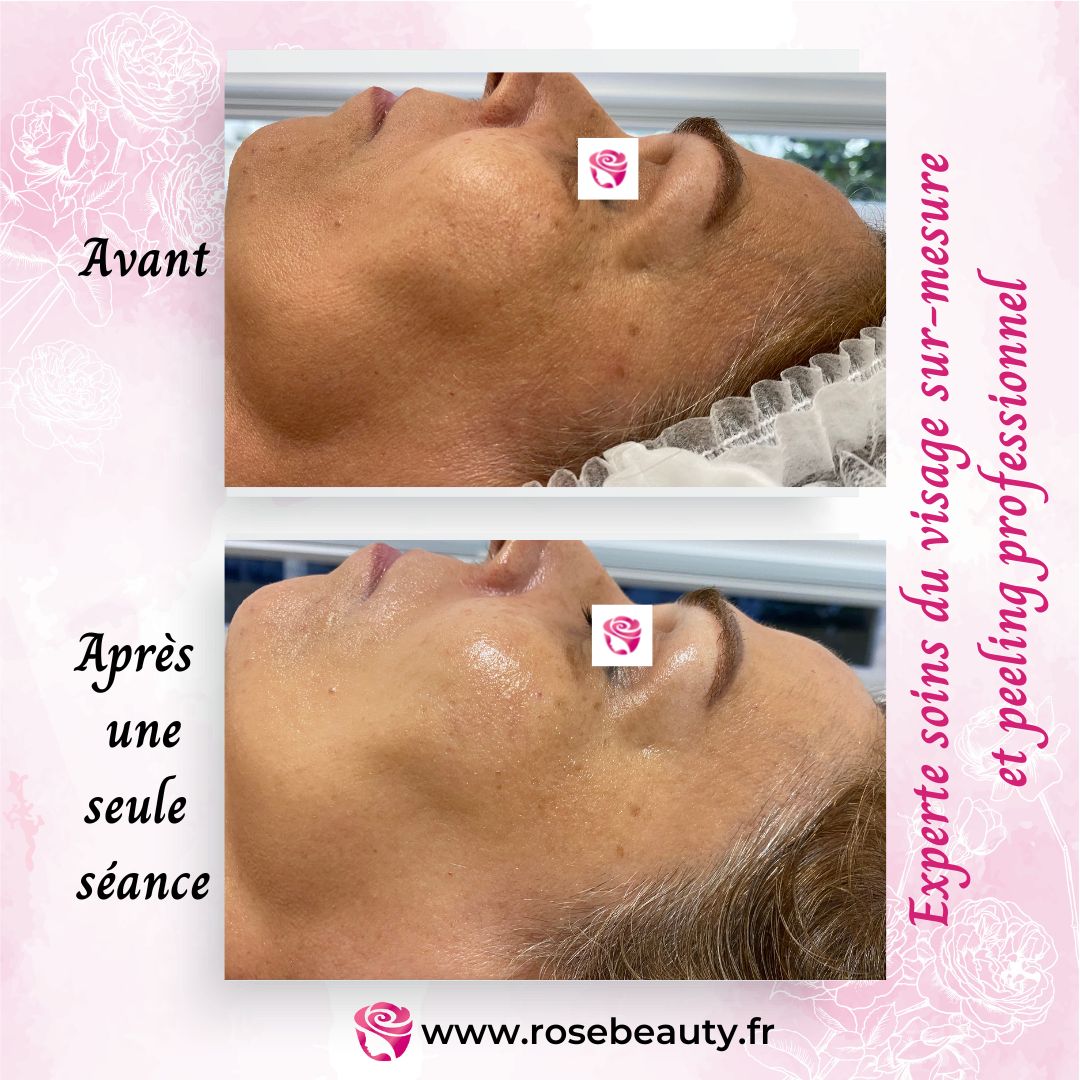 photo avant apres Rose Beauty