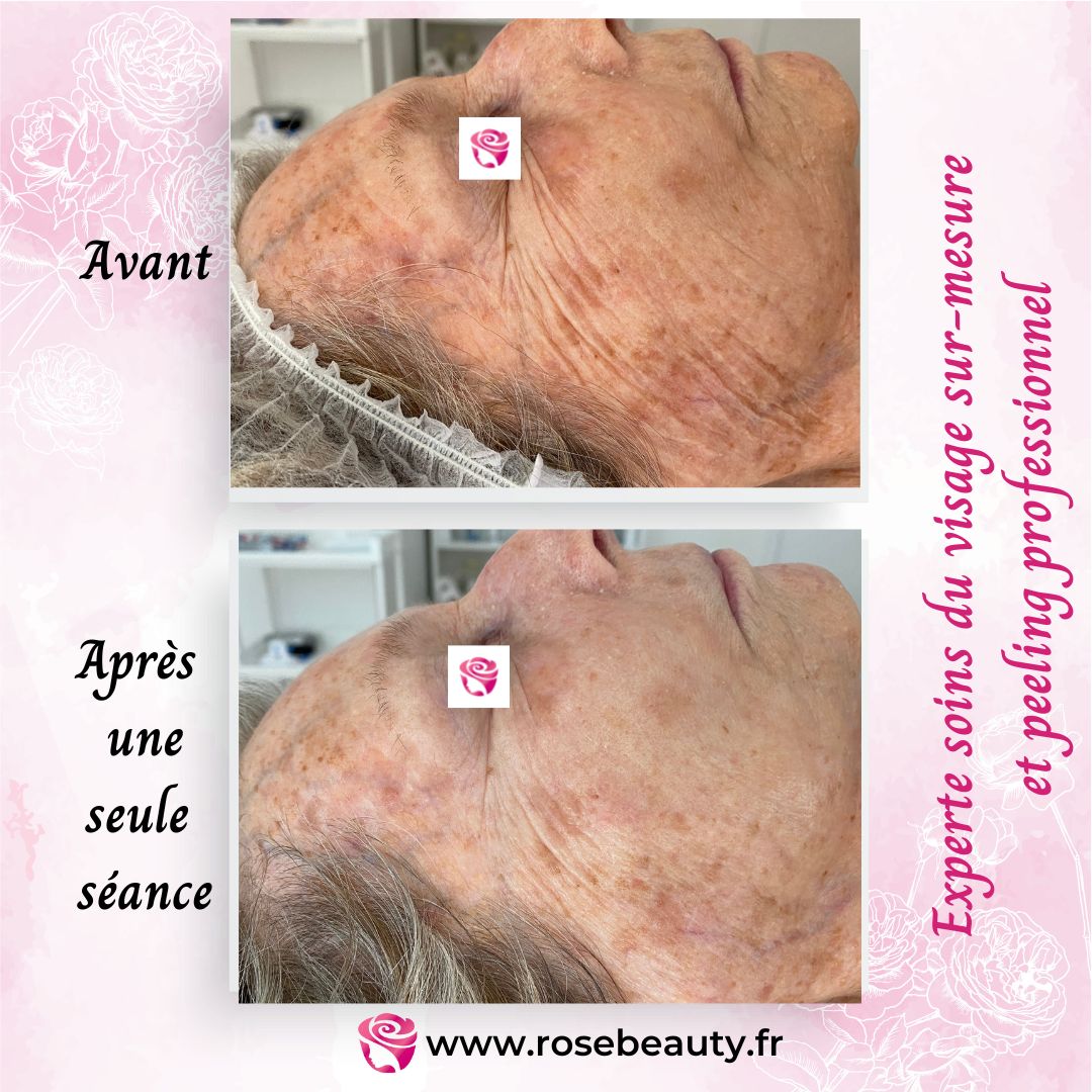 photo2 avant apres Rose Beauty