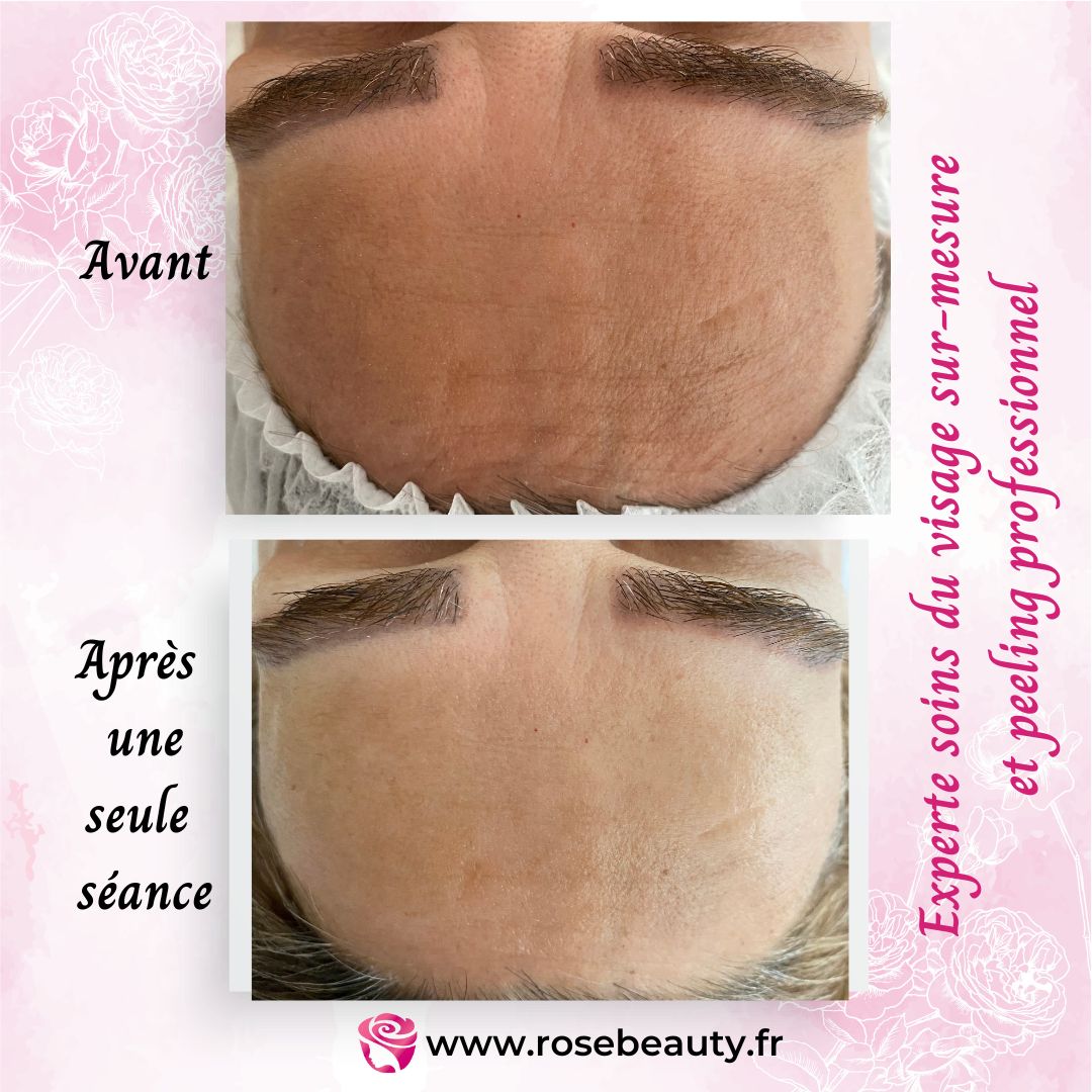 photo 1 avant apres Rose Beauty