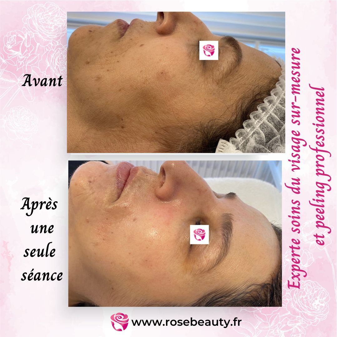 peeling professionnel