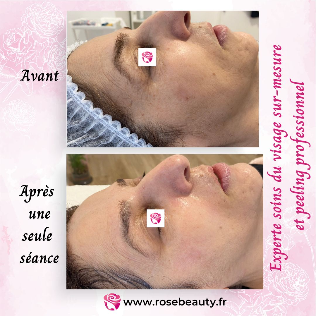 peeling professionnel 2